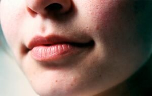Read more about the article Skincare Routine for Acne-Prone Skin in 2025: Clear Your Skin with Confidence