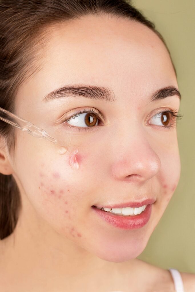 Hormonal Acne Naturally